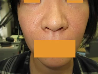 鼻翼縮小の術前