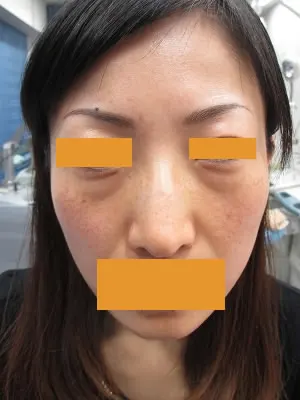 下眼瞼たるみ取りの術前