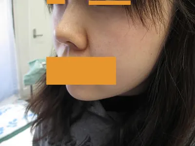 鼻翼縮小の術前
