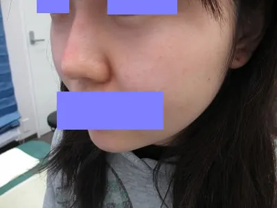 鼻翼縮小の術後