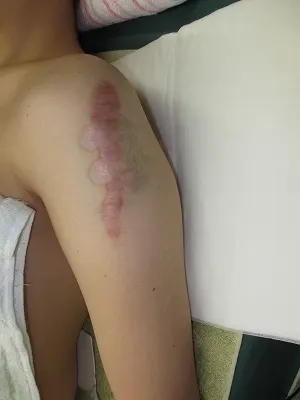 タトゥー（刺青）切除の術前