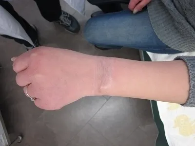 タトゥー（刺青）切除の術後