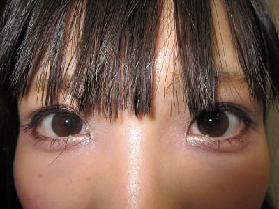 二重瞼（埋没法）の術後