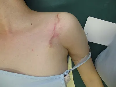 タトゥー（刺青）切除の術後