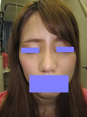 隆鼻術（プロテーゼ）の術後
