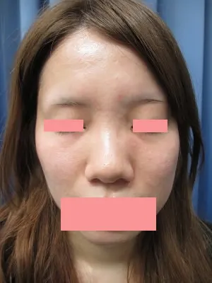 隆鼻術（プロテーゼ）の術前