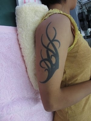 タトゥー（刺青）除去の術前