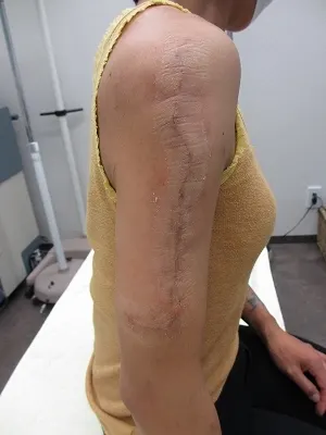 タトゥー（刺青）除去の術後