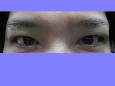 眼瞼下垂の術後