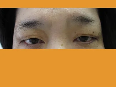 眼瞼下垂の術前