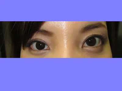 下眼瞼下制術の術後