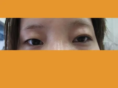 下眼瞼下制術の術前