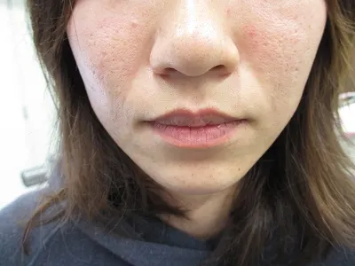 口唇　ヒアルロン酸の施注前