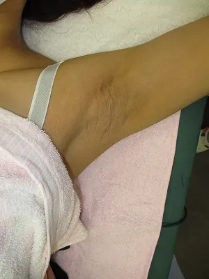 わきの傷跡修正の術後