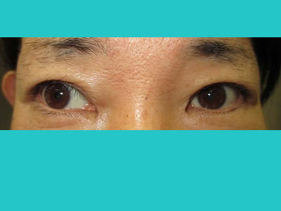 眼瞼下垂の術後