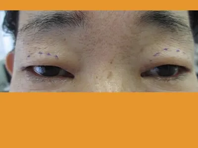 眼瞼下垂の術前