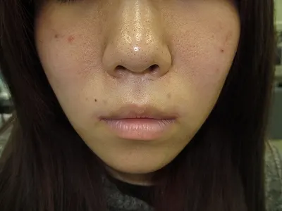 口唇拡大術の術前