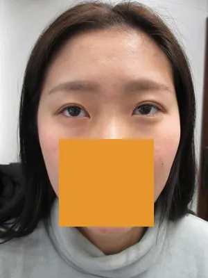 眼瞼下垂の術前