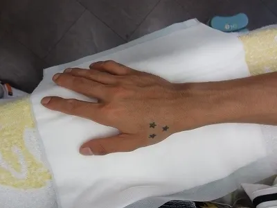 タトゥー（刺青）除去の術前