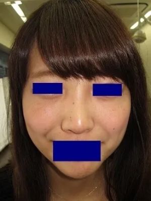 隆鼻術（ヒアルロン酸）の注入後