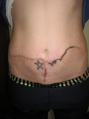 タトゥー（刺青）除去の1回目切除後