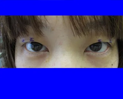 二重瞼（埋没法）の術前