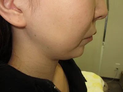 二重あごの治療（顎下の脂肪摘出術）の術前