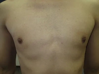 乳頭縮小（男性）の術後