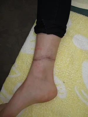 タトゥー（刺青）除去の術後