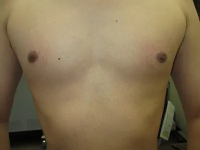 乳頭縮小（男性）の術後