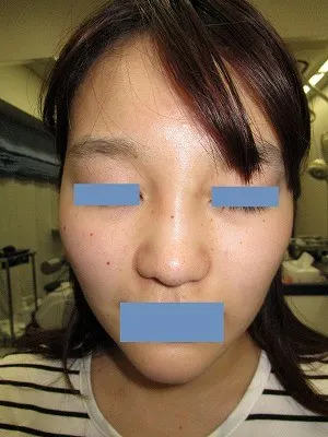 鼻尖形成術の術後