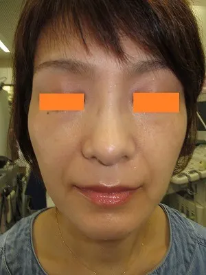 ヒアルロン酸（ほうれい線）の注入前