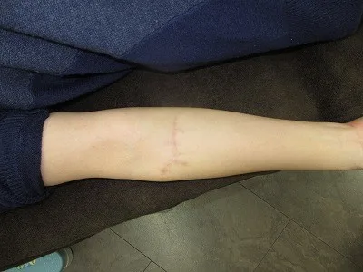 タトゥー（刺青）除去の術後