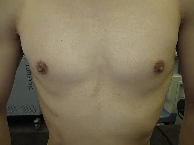 乳頭縮小（男性）の術前