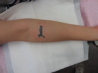 タトゥー（刺青）除去の術前