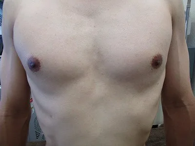 乳頭縮小（男性）の術後
