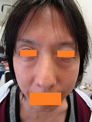 経結膜脱脂法（目の下のふくらみ取り）の術前