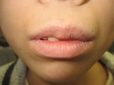 口唇のシミ（ラビアルメラノーシス）の照射後