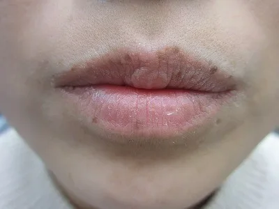 口唇のシミ（ラビアルメラノーシス）の照射前