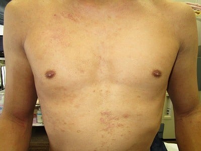 乳頭縮小（男性）の術後