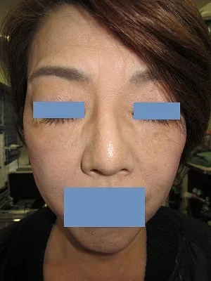 目の下のタルミ取り（ハムラ法）の術後