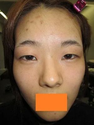 二重瞼（埋没法）の術前