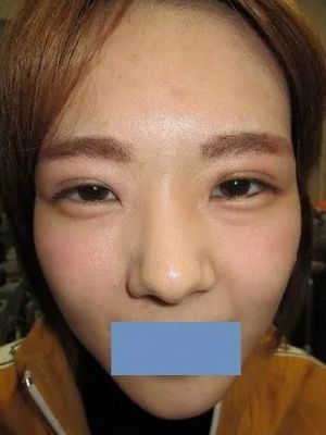 二重瞼（埋没法）の術後