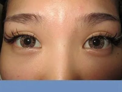 二重瞼（埋没法）の術後