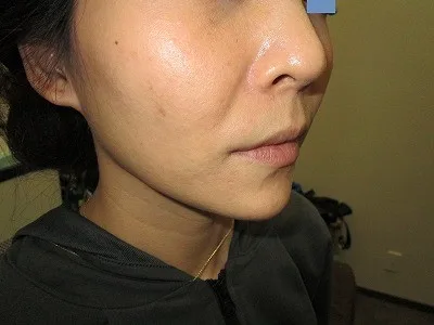顎　ヒアルロン酸の注入後