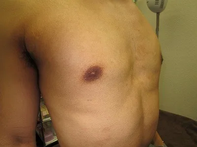 乳頭縮小（男性）の術後
