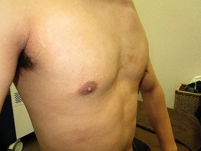 乳頭縮小（男性）の術前