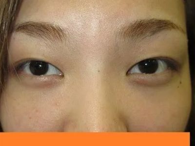 二重瞼（埋没法）の術前