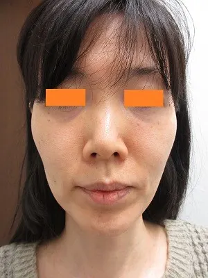 頬のタルミ治療の術前