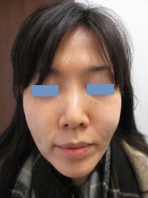 頬のタルミ治療の術後